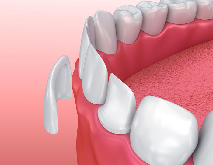 Dental bridges illustration