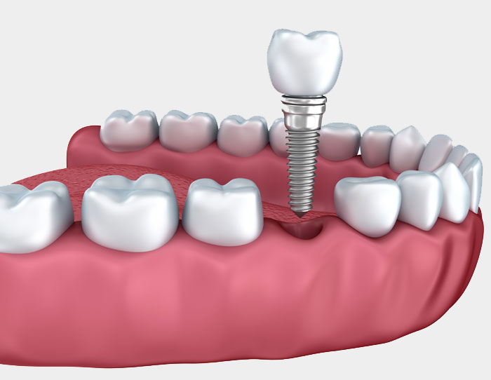 Dental implants illustration