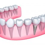 Replacing Missing Teeth in Riverview FL Area