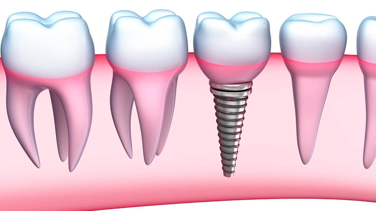 tooth replacement in Camarillo