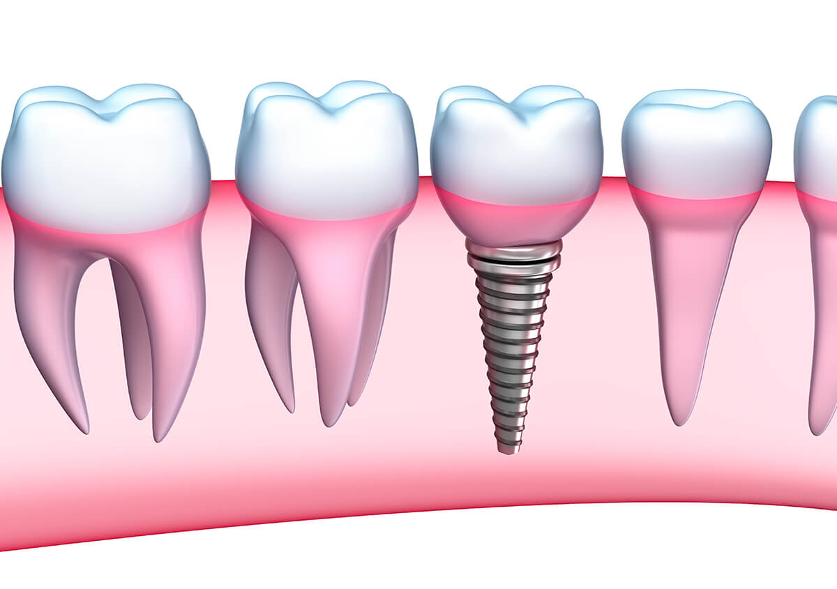 Dental Implants Dentist Near Me Riverview FL Area