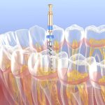 Root Canal in Riverview FL area