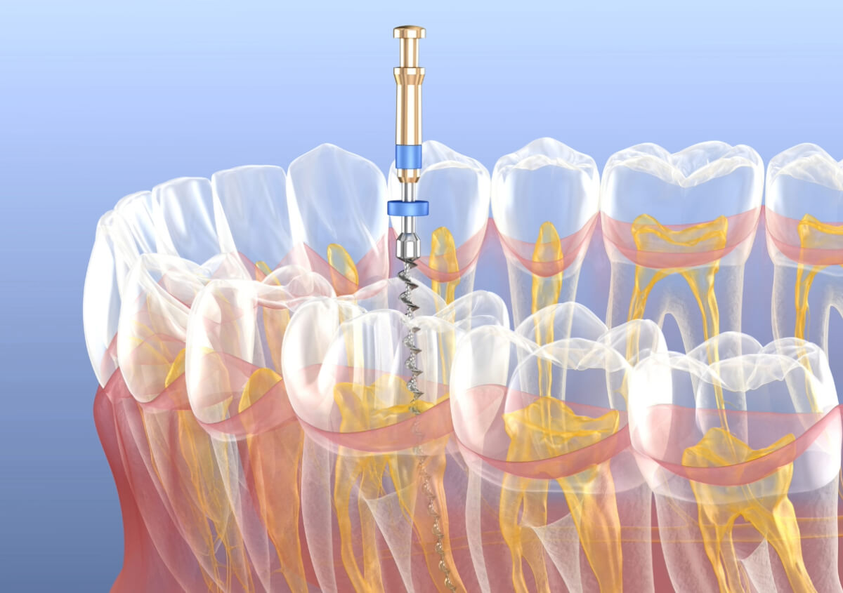 Root Canal in Riverview FL area