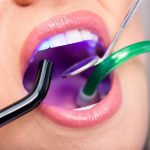 Laser Treatment for Teeth Cleaning in Riverview FL area